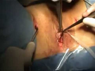TOT Procedure - Urinary Incontinence