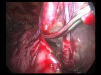 Kidney cyst resection 04.12.2012