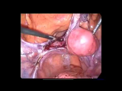Laparoskopik Histeroektamiya - laparoskopik usaqliq emeliyyati
