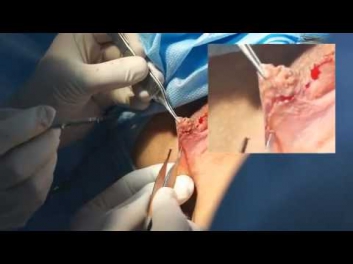 Labioplastika -qadin cinsiyyet dodaginin plastikasi